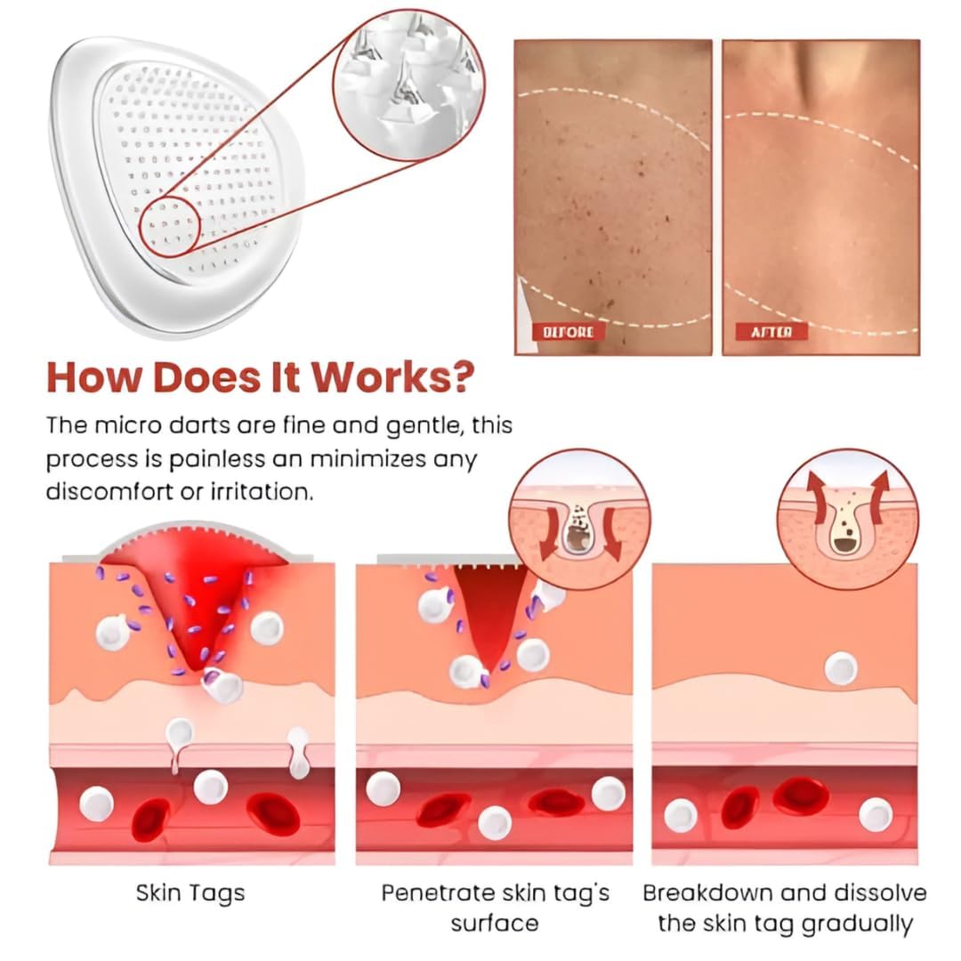 Derma Smooth Skin Tag Removal Patches - 36 Patches - DropSells