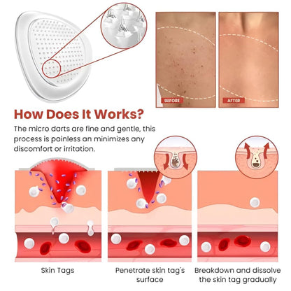 Derma Smooth Skin Tag Removal Patches - 36 Patches - DropSells
